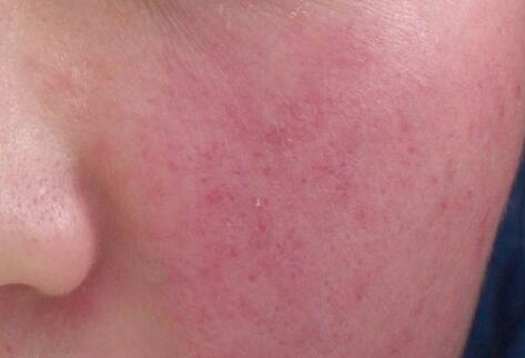 如何拯救你的敏感??？廣西南寧美容培訓(xùn)叫你正確方法