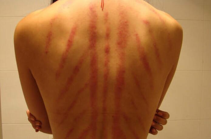 美容培訓：哪些人不是做背部刮痧