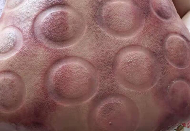 拔火罐有什么用？廣西美容職業(yè)培訓(xùn)學(xué)校演示給你看