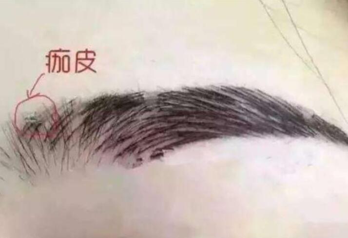 紋眉結(jié)痂時要注意什么？麗紋竹繡學(xué)校教你