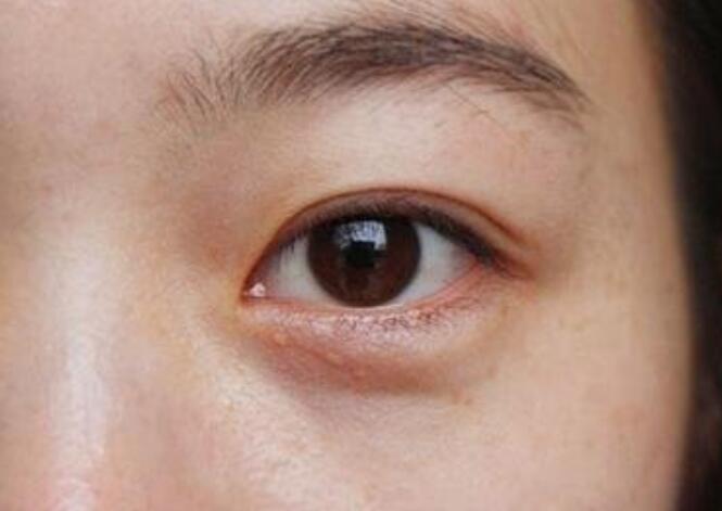 黑眼圈的種類有哪些？廣西美容培訓(xùn)教你保養(yǎng)