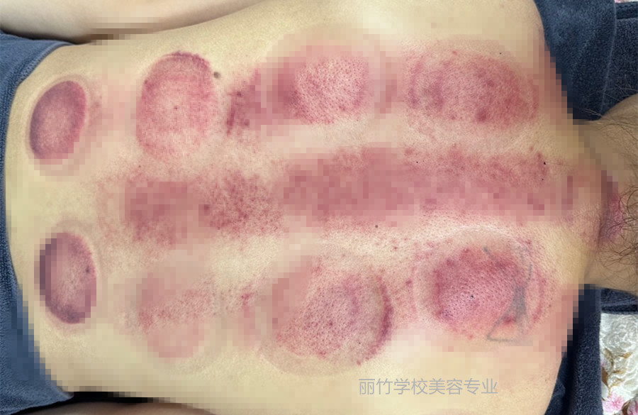 拔火罐的顏色代表什么？南寧美容美體專業(yè)實(shí)訓(xùn)