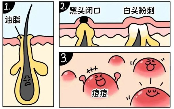 不同部位閉口形成的原因，南寧美容護膚學校解答