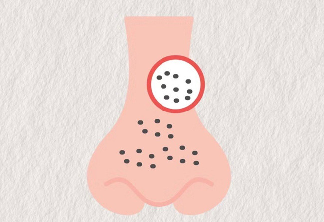 廣西皮膚管理師：面對嚴重的黑頭應該怎么辦？